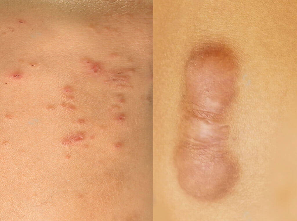 Difference between keloid and irritation bump