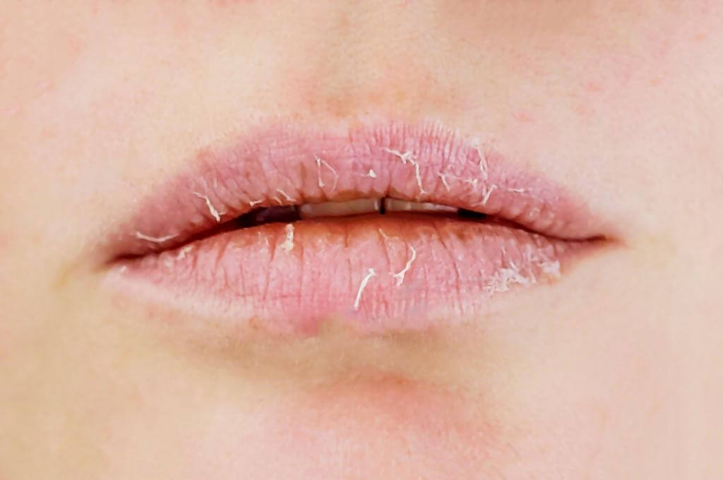 why-are-my-lips-always-dry-and-peeling-top-20-reasons-and-solutions